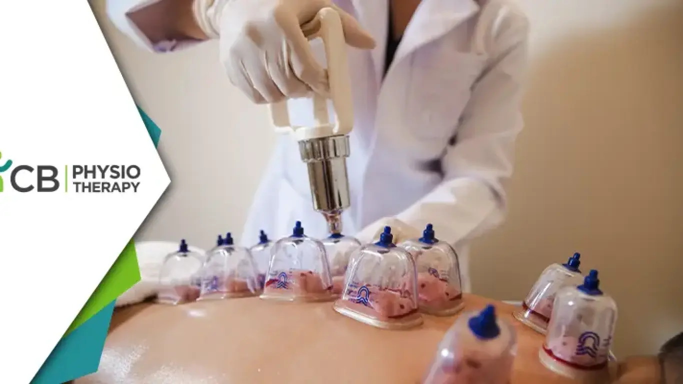 Cupping Therapy(hijama) | Unlocking Health Benefits In Physiotherapy