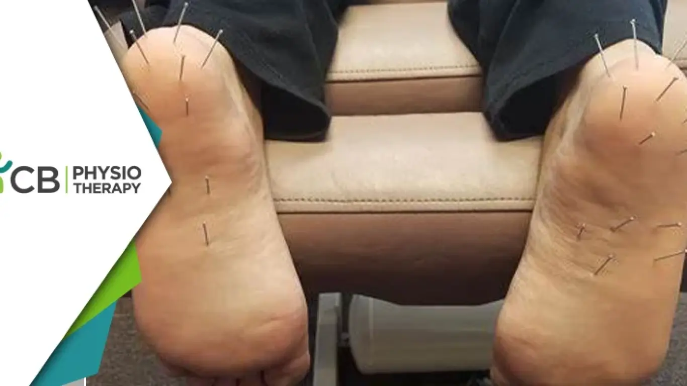 Dry Needling For Plantar Fasciitis | How It Can Help In The Management Of Heel Pain?