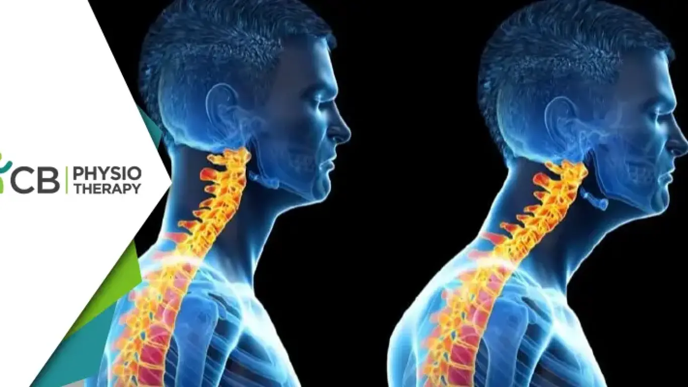 Forward Head Posture | Understanding Its Impact On Neck And Shoulder Pain And How Physiotherapy Can Provide Relief?