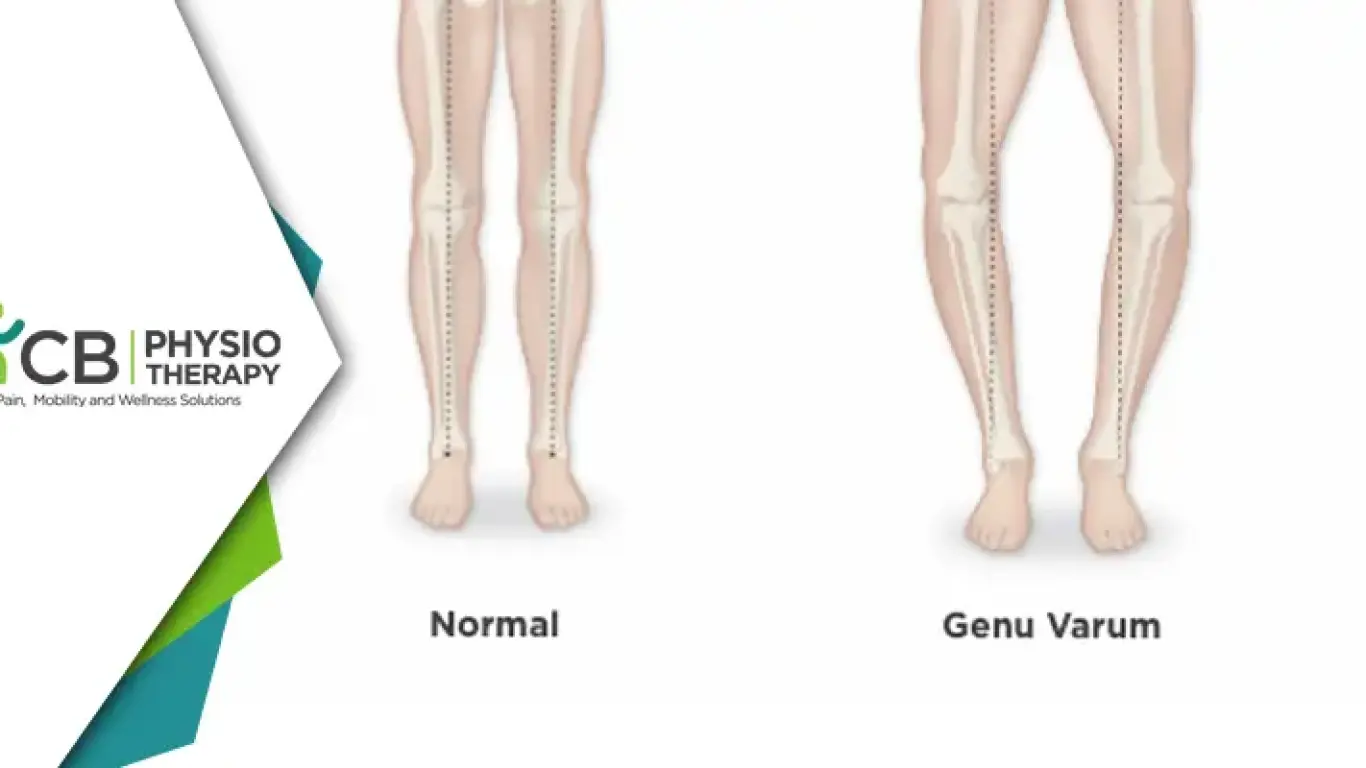 Genu Varum In Kids | A Physiotherapy Approach For Better Health.