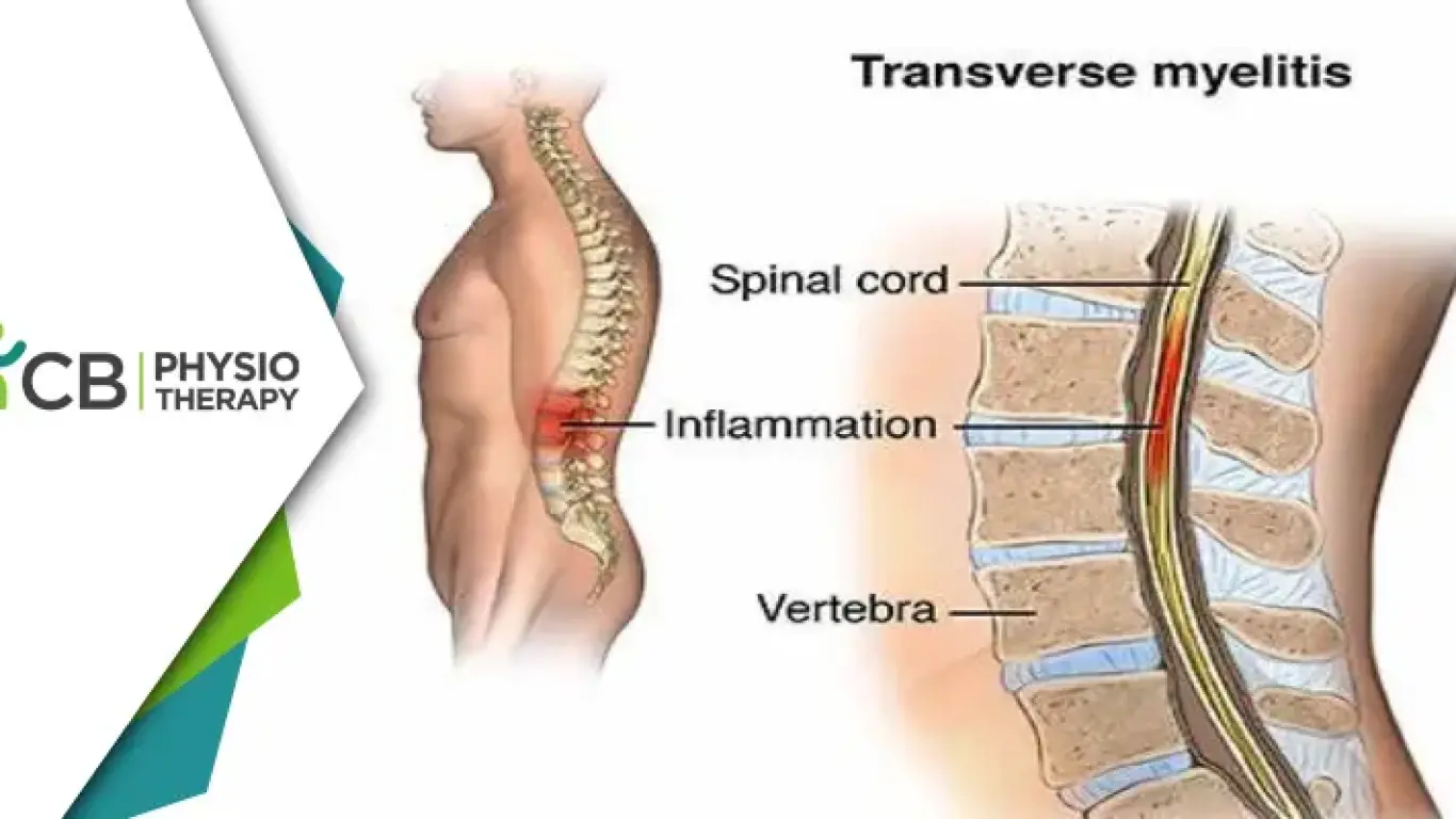 Transverse Myelitis | Managing Muscle Weakness And Regaining Mobility Through Physiotherapy