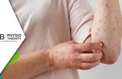 Physiotherapy In Leprosy | A Guide To Help People With Injury And Disability
