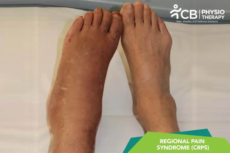 Complex Regional Pain Syndrome (crps)