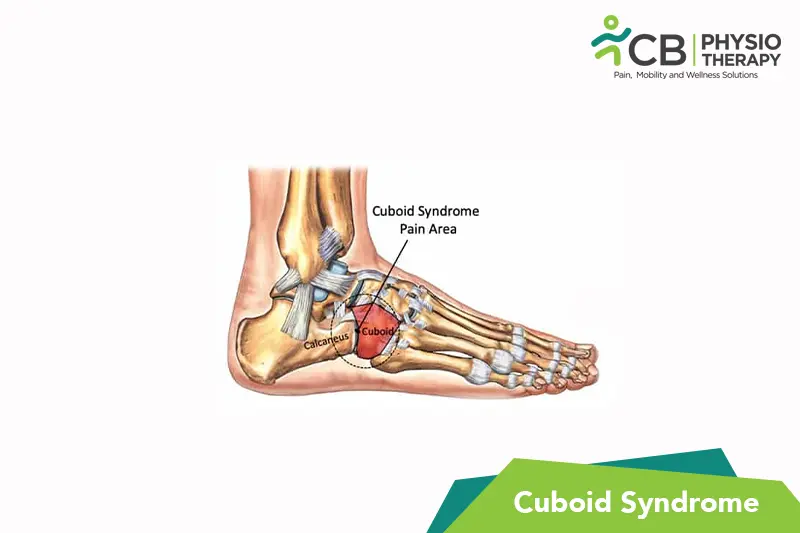 Cuboid Syndrome