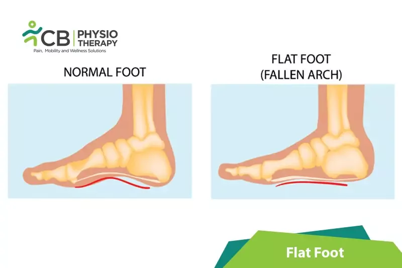 Flat Foot