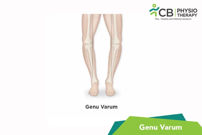 Genu Varum