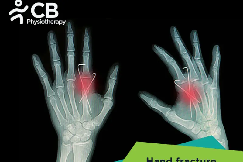 Hand Fractures