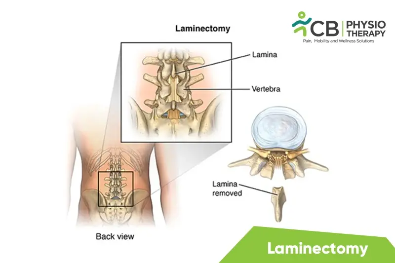 Laminectomy
