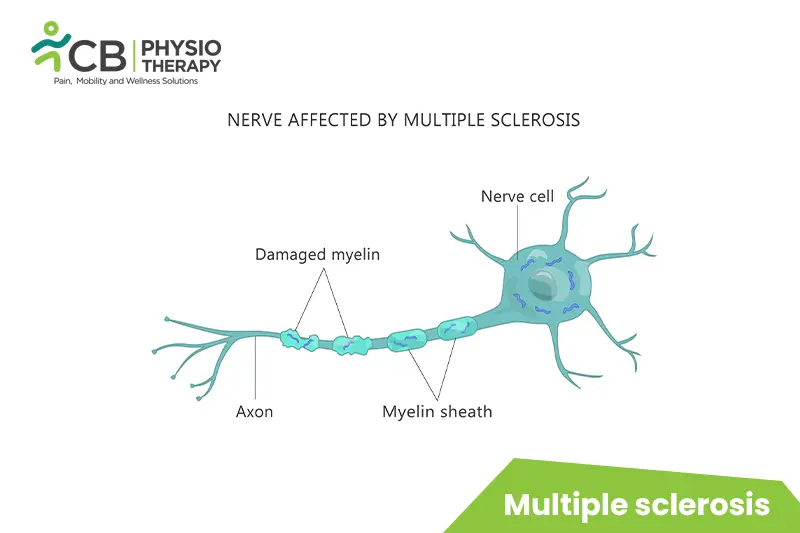 Multiple Sclerosis