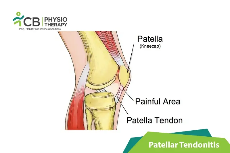 Patellar Tendonitis