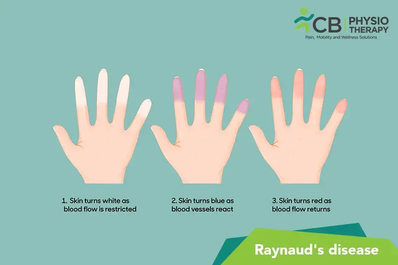 Raynaud’s Disease