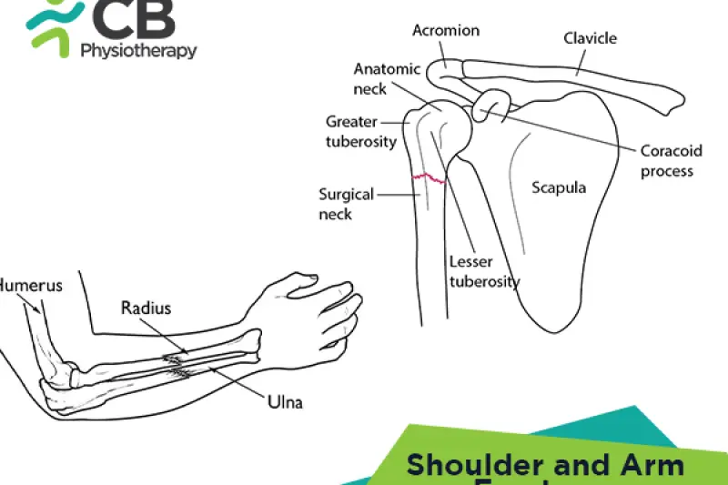 Shoulder And Arm Fractures