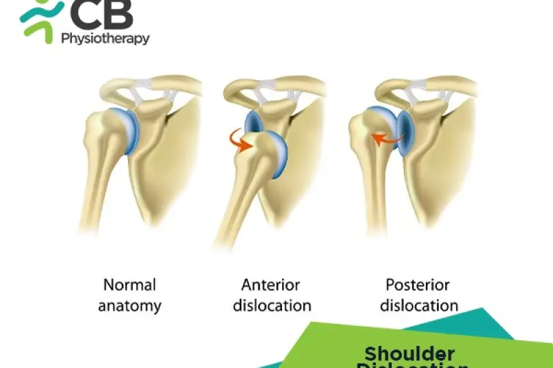 Shoulder Dislocation