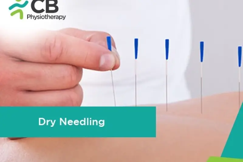 Dry Needling Therapy