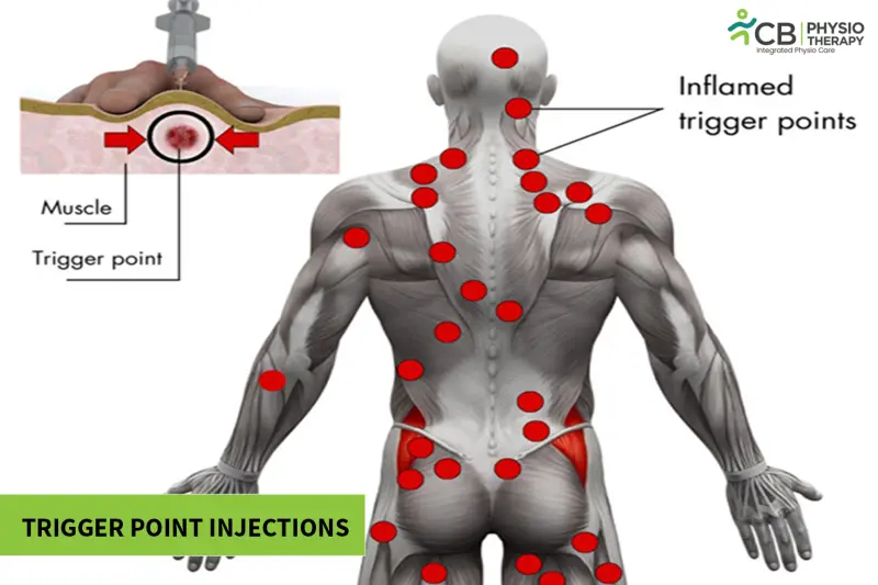 Trigger Point Injection